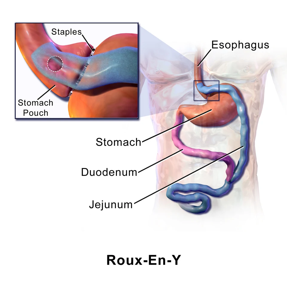 Roux-en-Y gastric bypass: a small stomach pouch connects to a rerouted segment of small intestine.