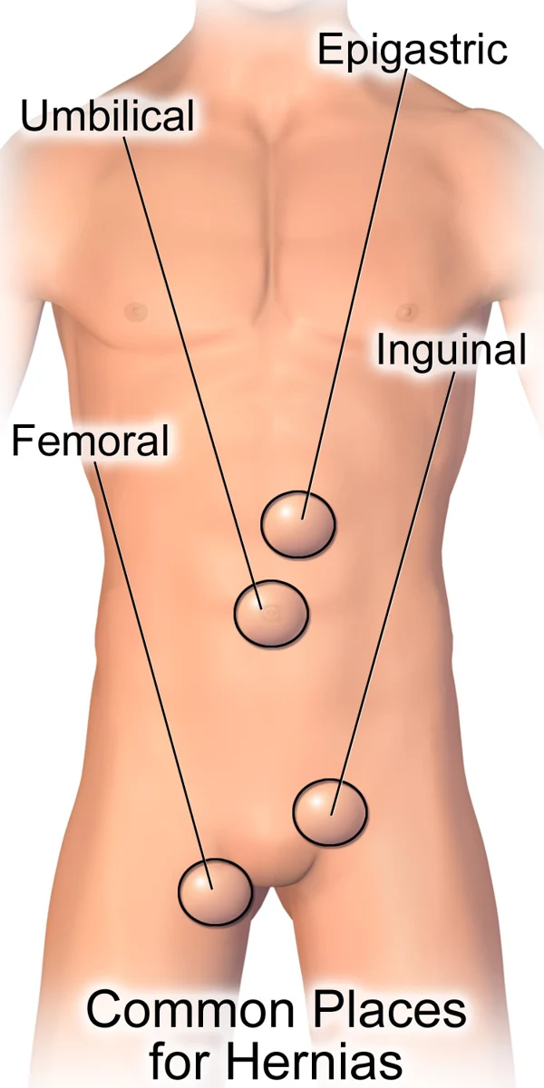 Common abdominal and groin hernia locations; location helps distinguish the types.